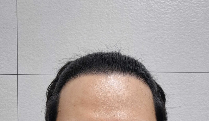 앞머리이식 비절개 18개월 - 다나성형외과, 2400모