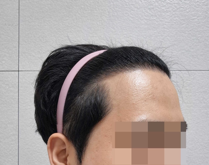 비절개모발이식18개월.jpg