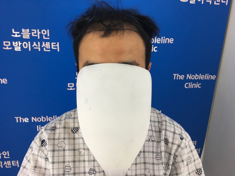 手術から6か月が経過しています。