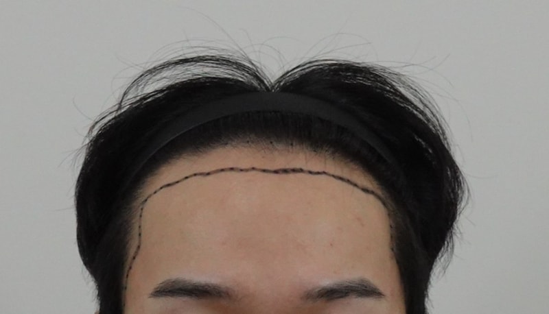 모발이식하고 바로 후기 써봄