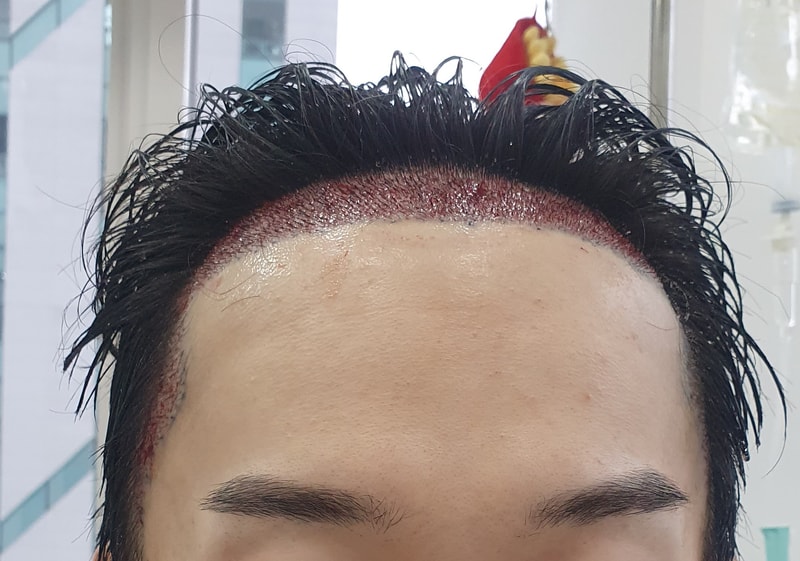수술직후.jpg