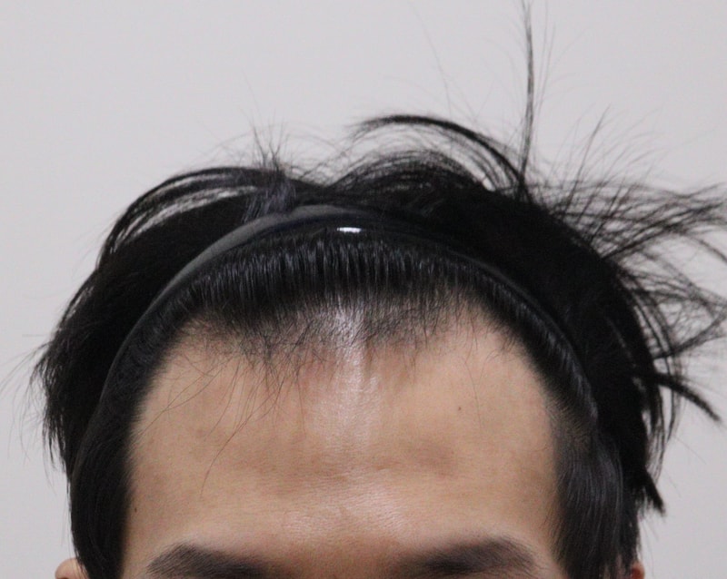1. 수술전_1.JPG