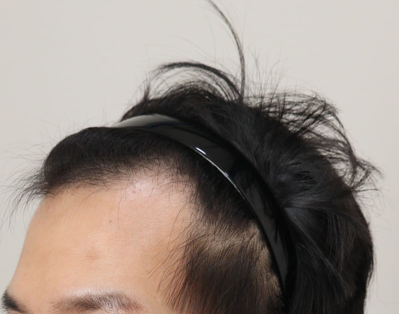 1. 수술전_2.JPG