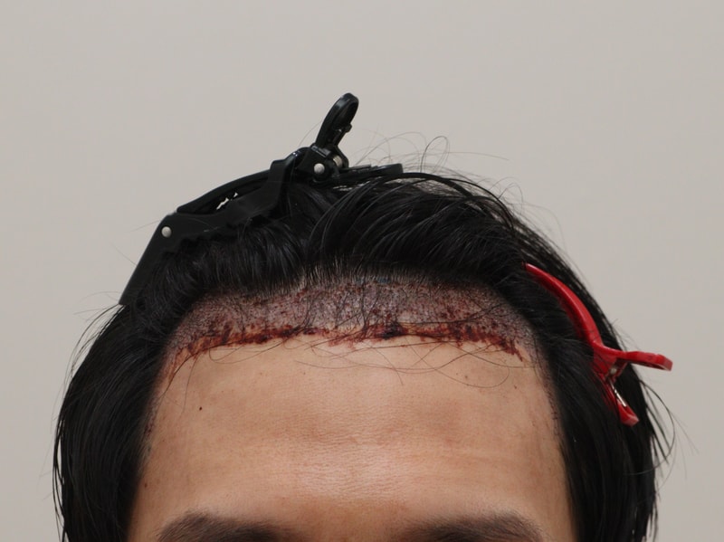 2. 수술후1일_1.JPG