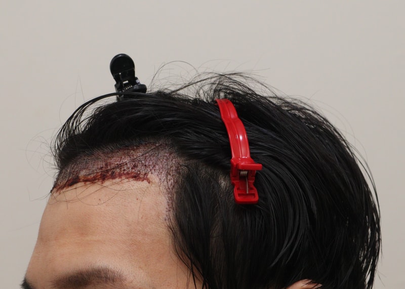 2. 수술후1일_2.JPG