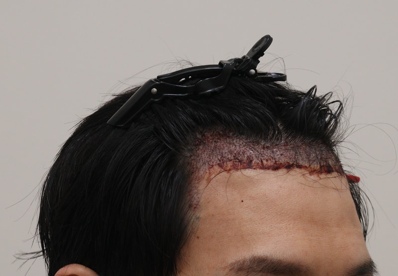 2. 수술후1일_3.JPG