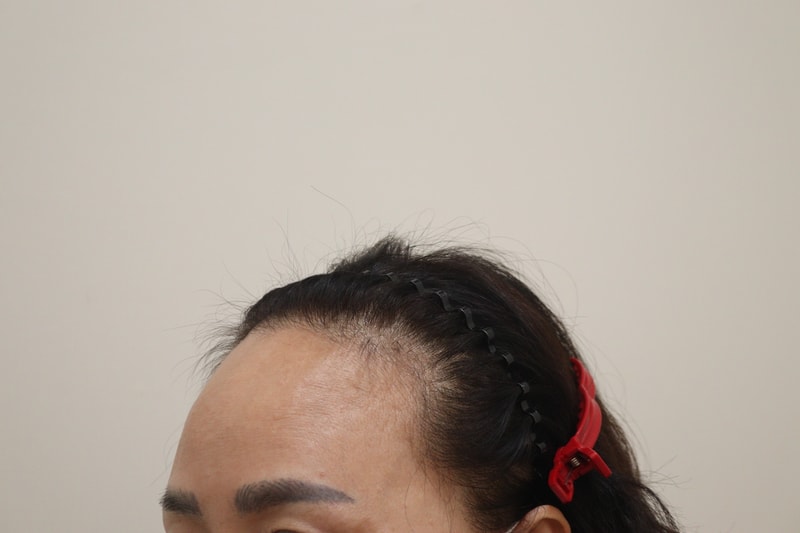 1. 수술전_2.JPG