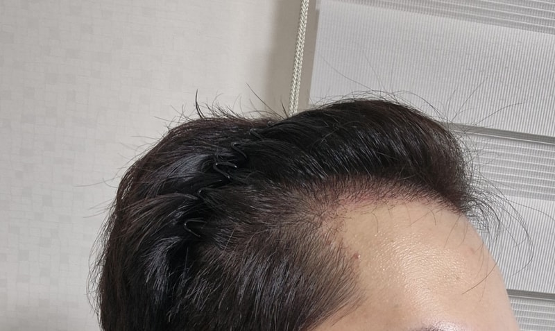 무삭발비절개후30일.jpg