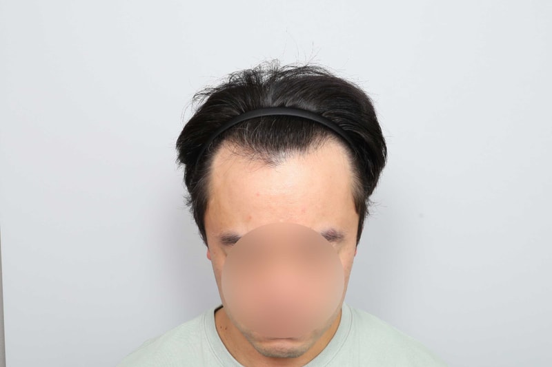 M자 이마 무삭발비절개 1600모낭 11개월차 모원성형외과 정재홍원장님