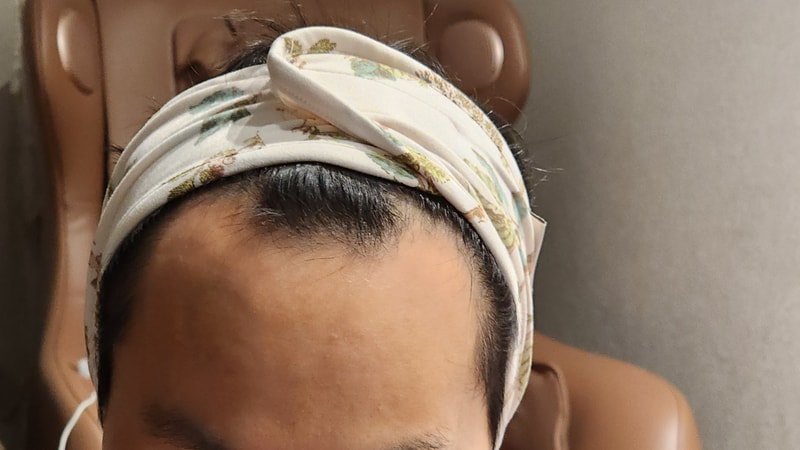 동탄 헤어로의원 3주차 모발이식 후기