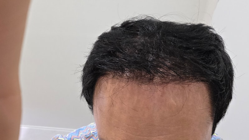 [헤어로의원 동탄점], [2주차경과], [모발이식] 후기입니다.