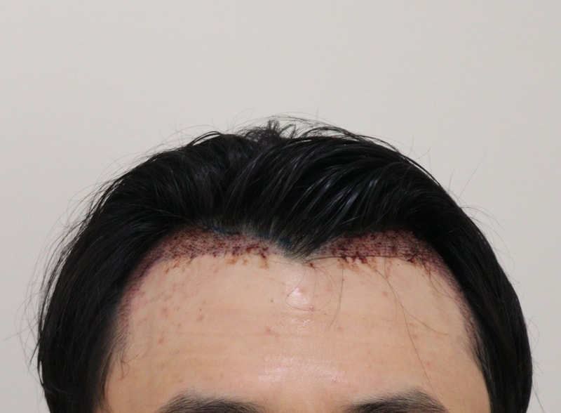2. 수술후_1일_1.JPG