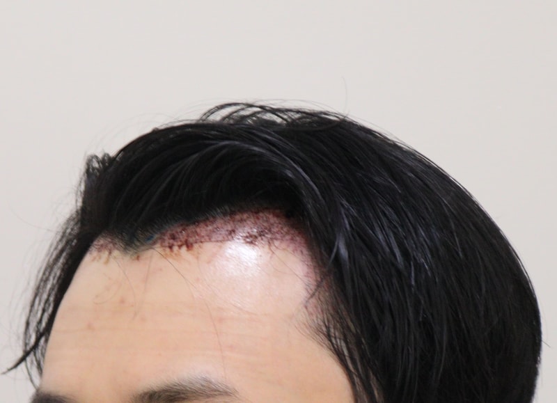 2. 수술후_1일_2.JPG