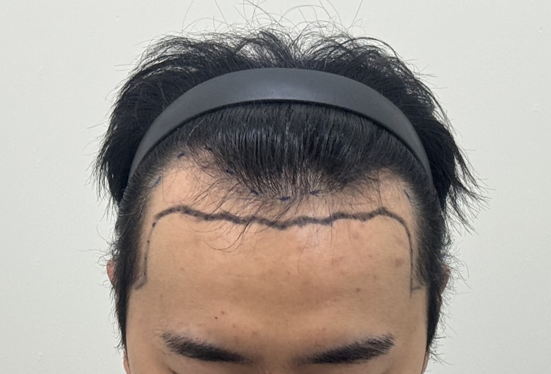 비절개 모발이식 라인컷 3500모 1차 수술 후기 남깁니다