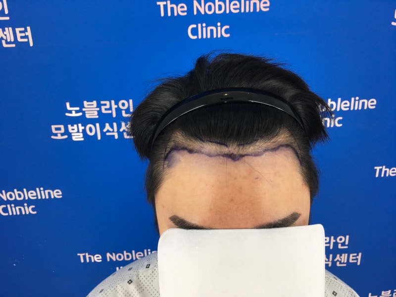 Nine months, the Hair Transplant is the best even if you look at it.