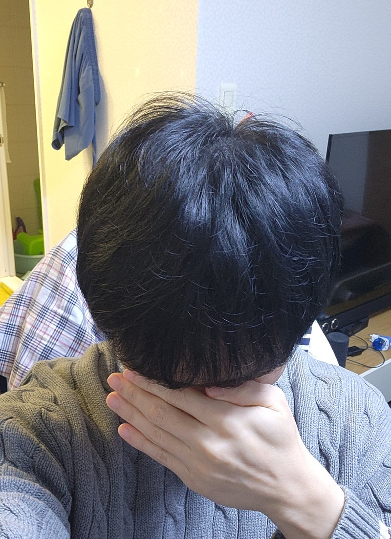 모발이식_9개월차.jpg