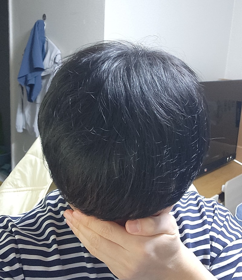 모발이식_12개월차.jpg