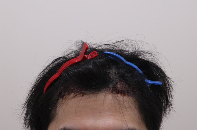 2. 수술후_1일_.JPG