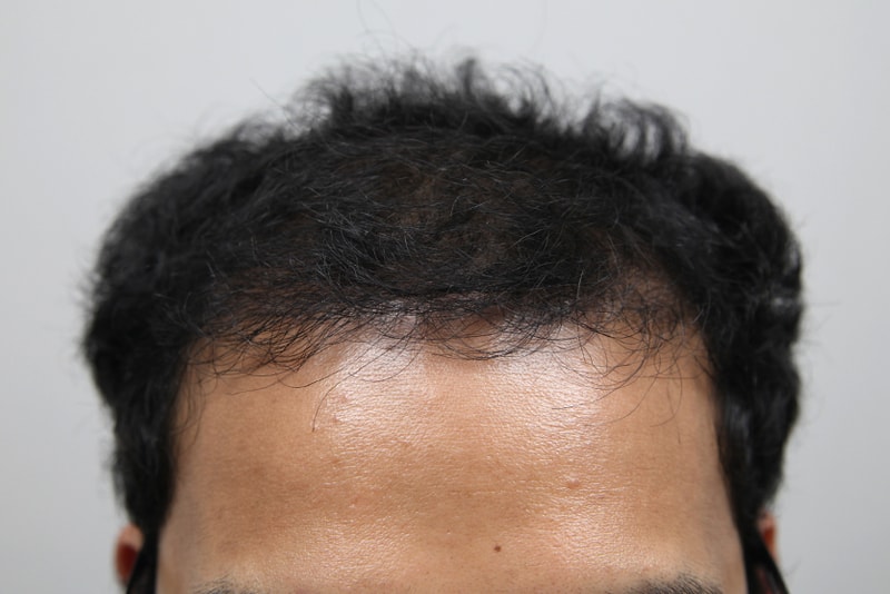 Monara 5,000 Mo Four Months to the Top of the Head! (Special feature: Too Curly)