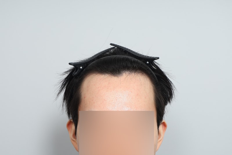 무삭발 헤어라인 모발이식 1400모낭 2주차 모원성형외과