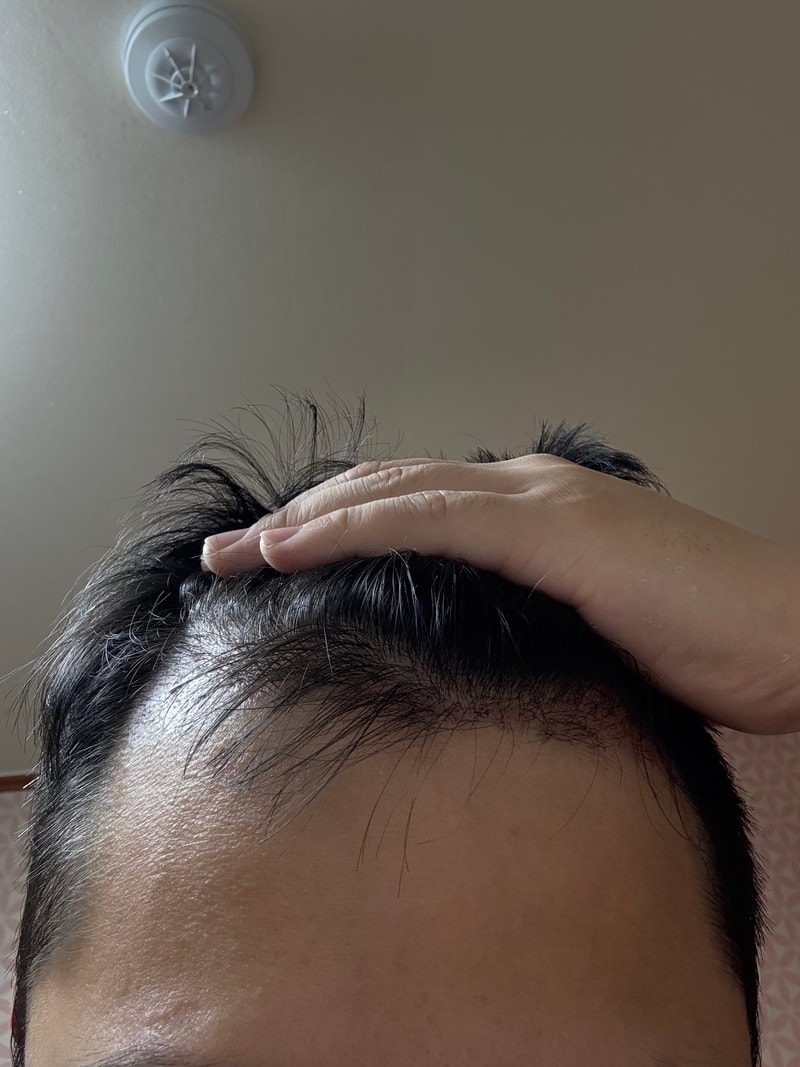 Everyone, pay attention to density and design. 30 days of Dana Plastic Surgery hairless 800 hair follicles.