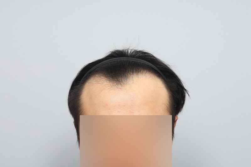 m자이마 비절개 헤어라인 모발이식 1700모낭 2주차 모원성형외과 정재홍원장님