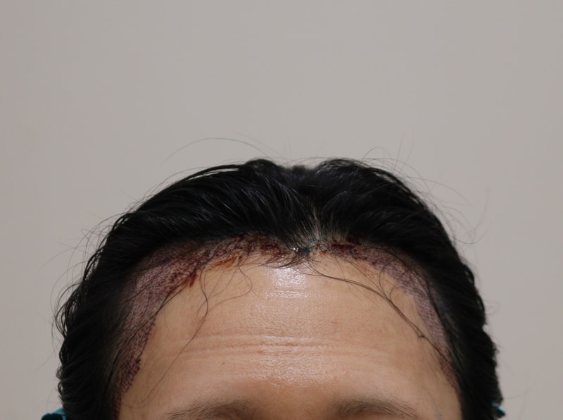 2. 수술후_1일_1.JPG