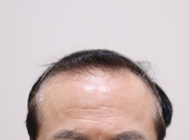 1. 수술전_1.JPG