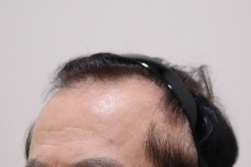 1. 수술전_2.JPG
