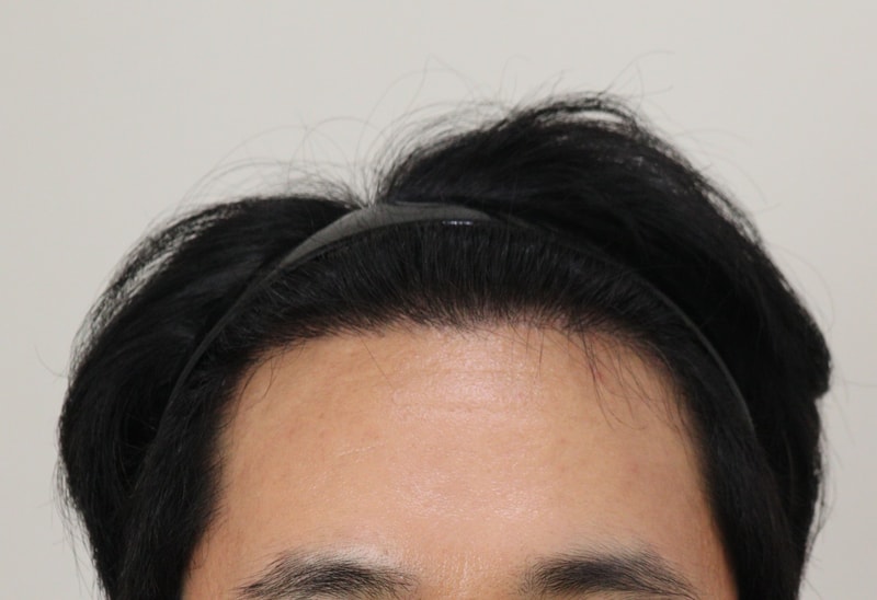 3. 수술후_6개월_1.JPG