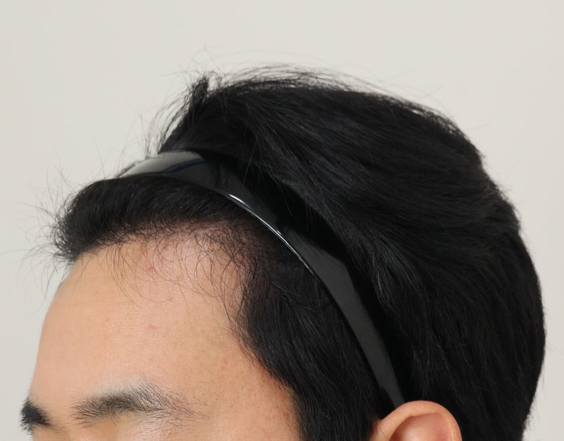 3. 수술후_6개월_2.JPG