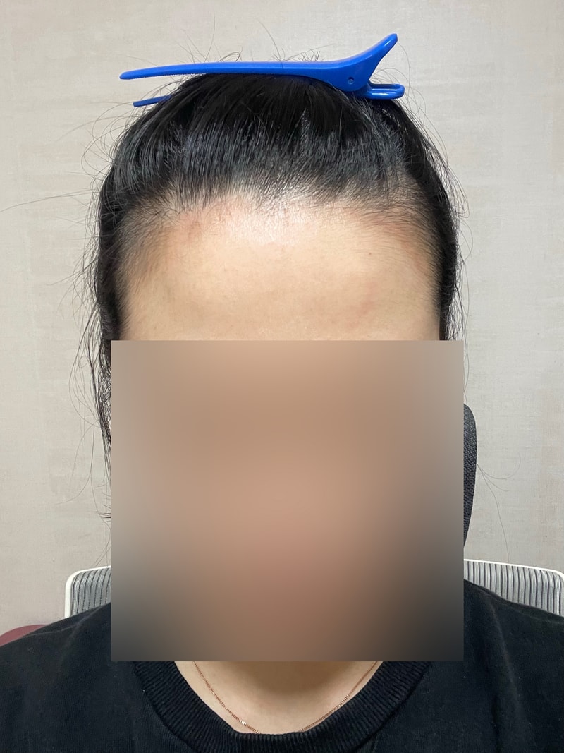 MO.1成形外科医院ヘアライン植毛 1200毛包 10日目 パク・ジョンオク院長