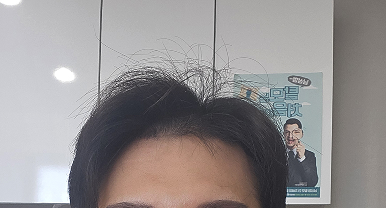 3- 병원에서 2주차 각질샴푸 받고 찍어본 사진입니다 안빠진 머리는 그래도 자라고 있고 이식모도 짧게 자라서 채워진 느낌이라 머리 까버렸어요.jpg