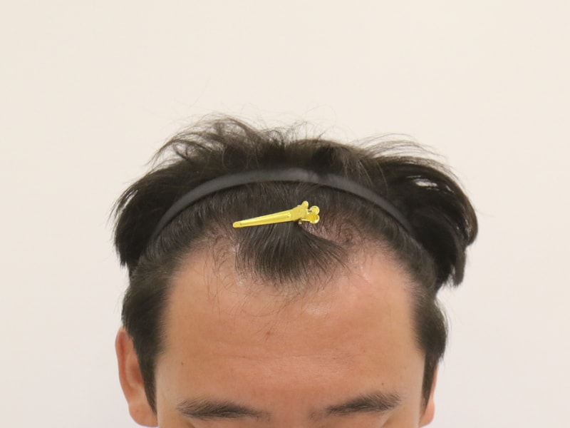Busan Hair Transplantation Slit Method Mammoth Hair Restoration Center M-shape + Front Head 8 months have passed