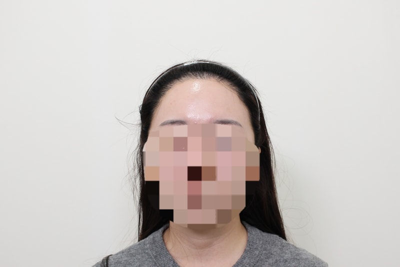 Sinsa Station, Mopro Clinic, Director of Mungeon Academy, 4,300 hairline incision, 6 months have passed