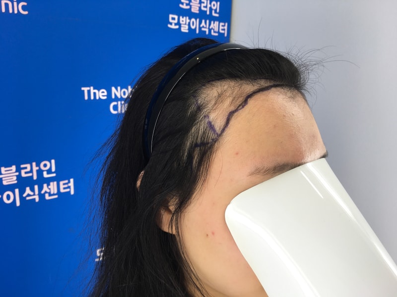 모발이식 받고 진짜 세상이 달라졌습니다.
