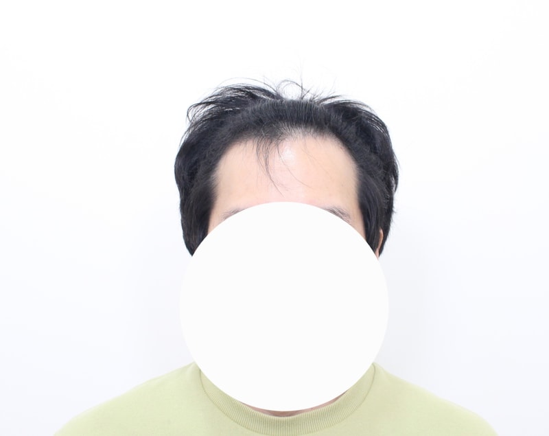 모프로의원 헤어라인 모발이식 비절개 3400모 1년 경과