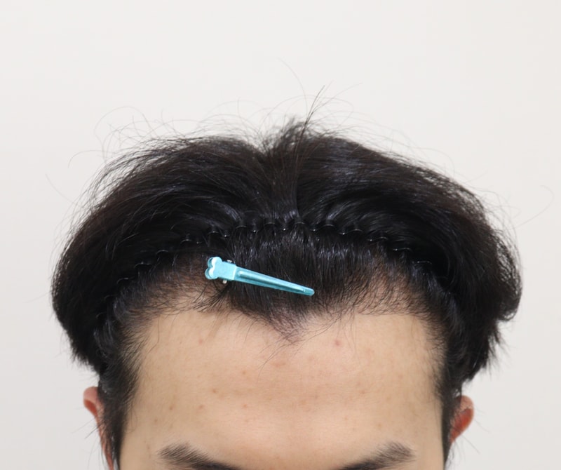 1. 수술전_1.JPG