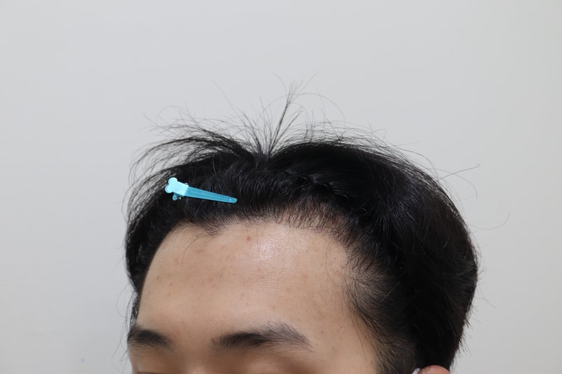 1. 수술전_2.JPG