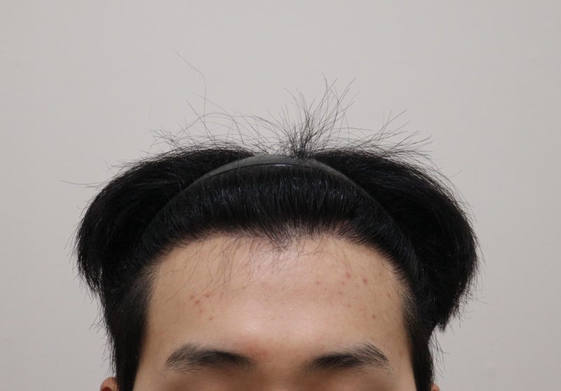 3. 수술후_6개월_1.JPG