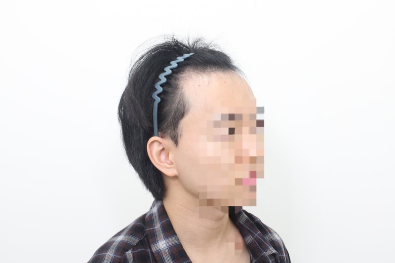 신사역 모프로의원 모발이식6개월 후기