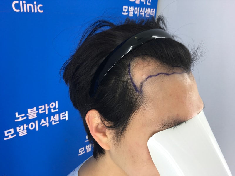 엠자 모발이식 수술 13개월 후기