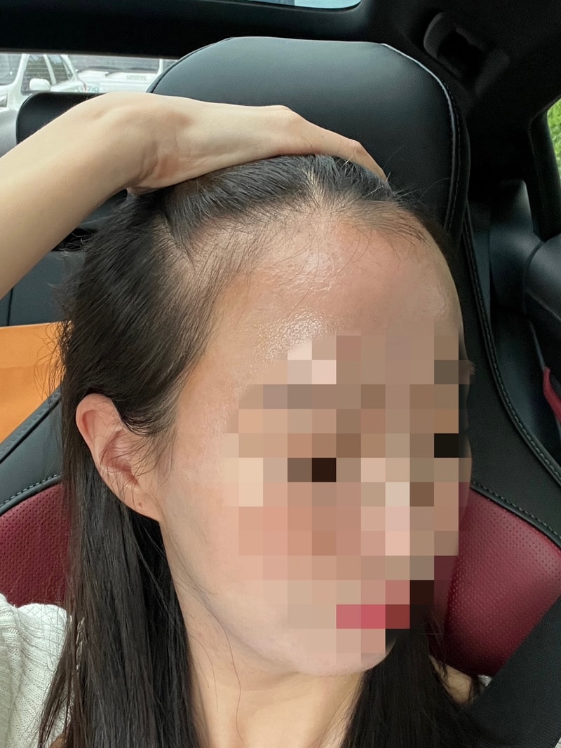 모원성형외과 여자 비절개 모발이식 1500모낭 7개월차