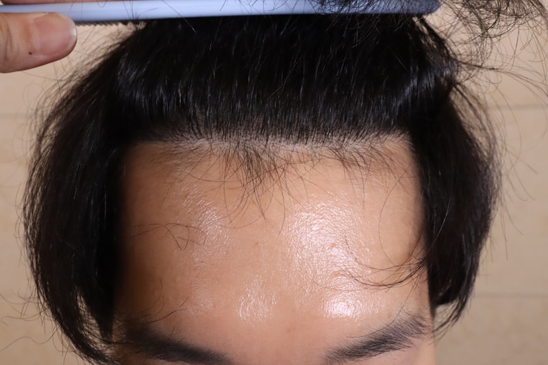 움찬병원 비절개 모발이식 1년차 후기입니다.