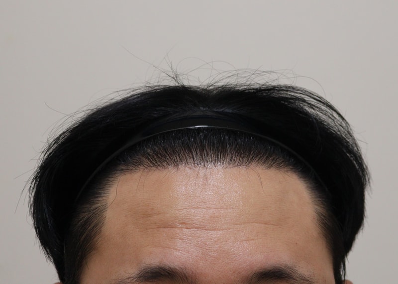 3. 수술후_6개월_1.JPG