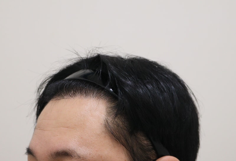 3. 수술후_6개월_2.JPG