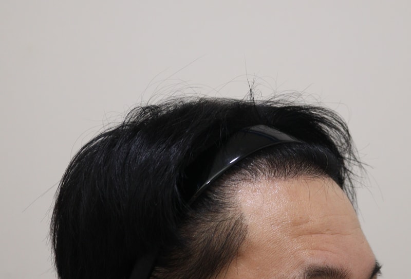 3. 수술후_6개월_3.JPG