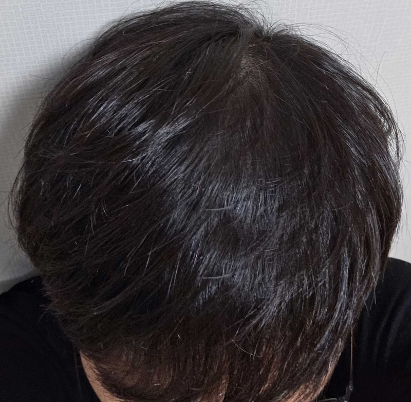 가르마탈모에는 대량이식이 찐이네요. 다나 5000모 비절개 18개월 경과