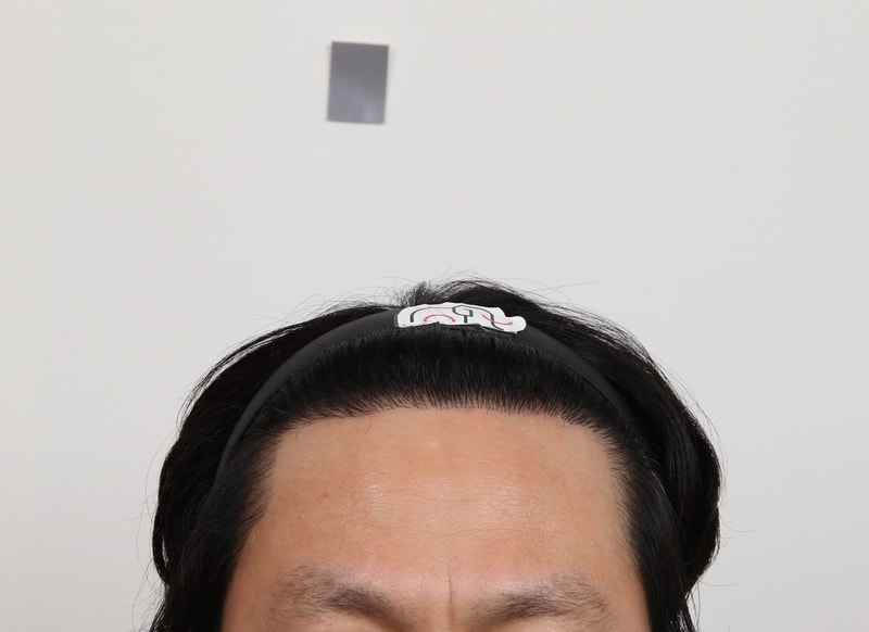 부산모발이식 슬릿방식 맘모스 M자 8개월 경과