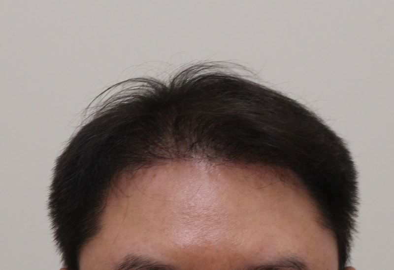 4. 수술후_6개월_1.JPG